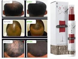 Baldness solution in kenya